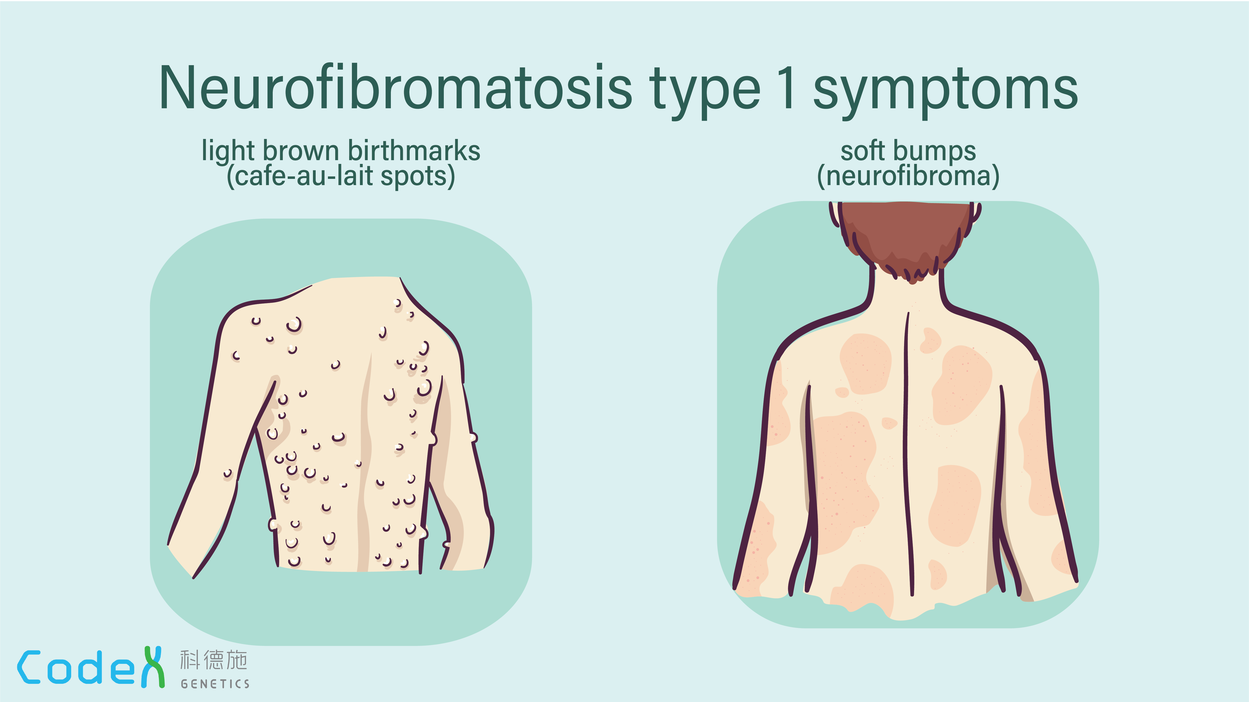neurofibromatosis type i